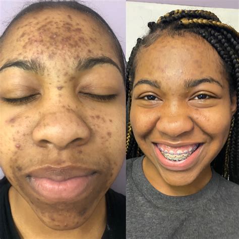 Chemical Peel St. Louis – Chemical Peel for Brown .